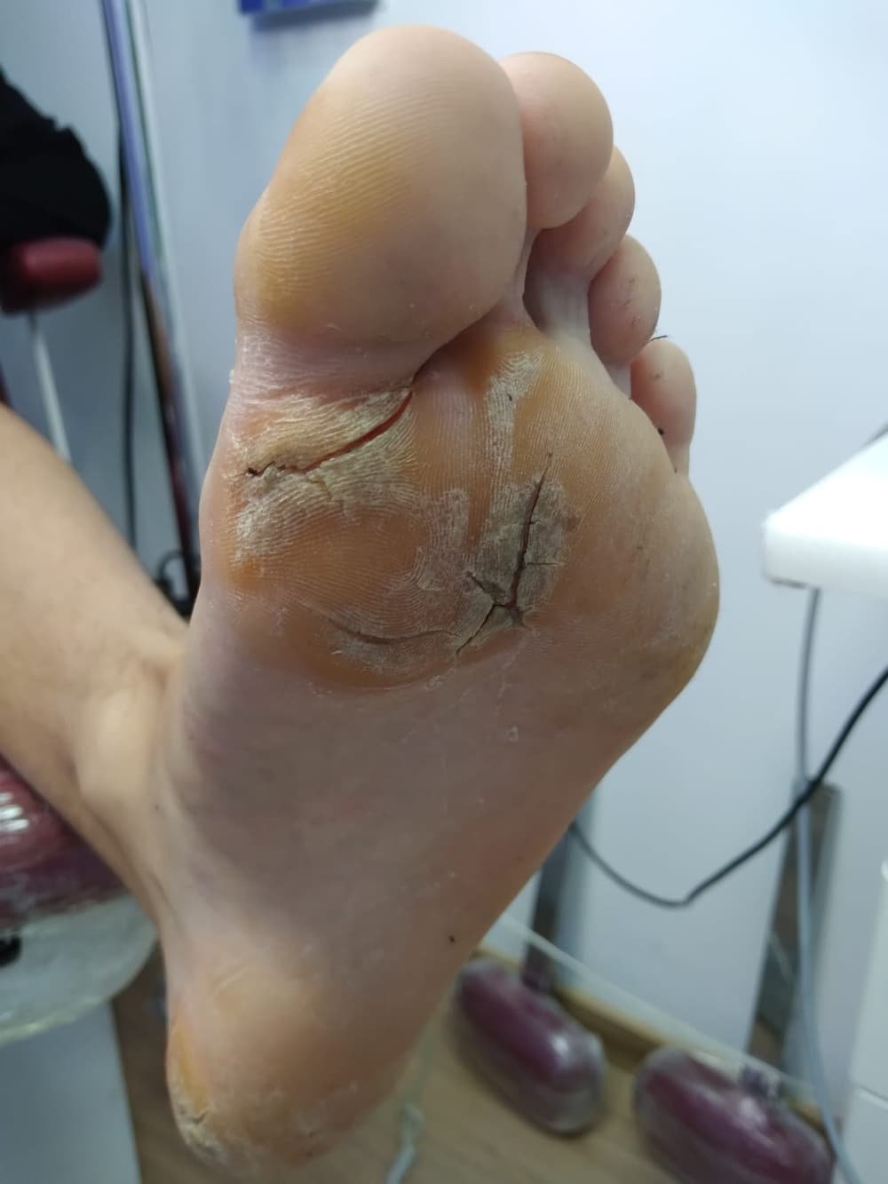 Planta do pé com fissuras e pele ressecada, antes do tratamento